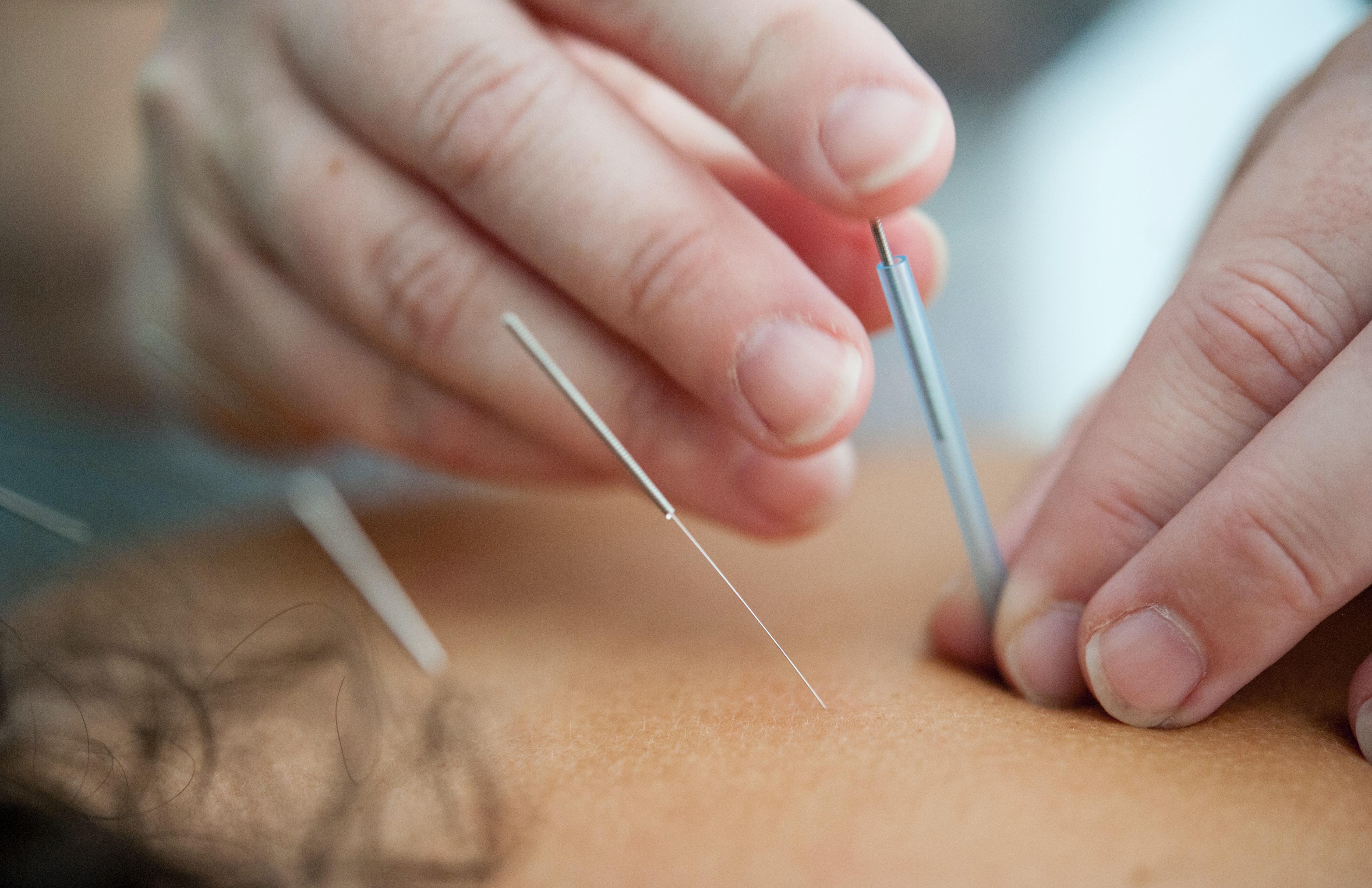 Acupuncture for Mental Health