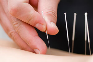 Acupuncture Picture